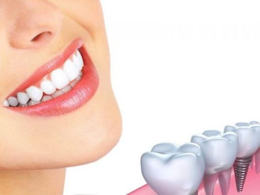 Vệ sinh răng miệng đúng cách sẽ giúp tăng tuổi thọ răng Implant