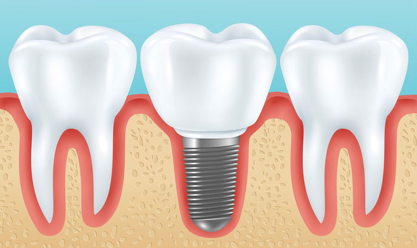 Khi nào cần cấy ghép Implant