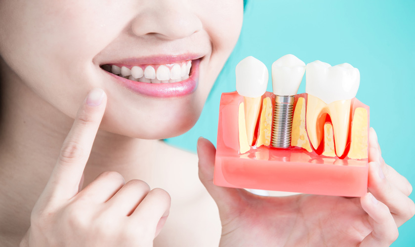 Răng nhổ sau bao lâu thì trồng Implant lại được? Ngay sau khi nhổ răng