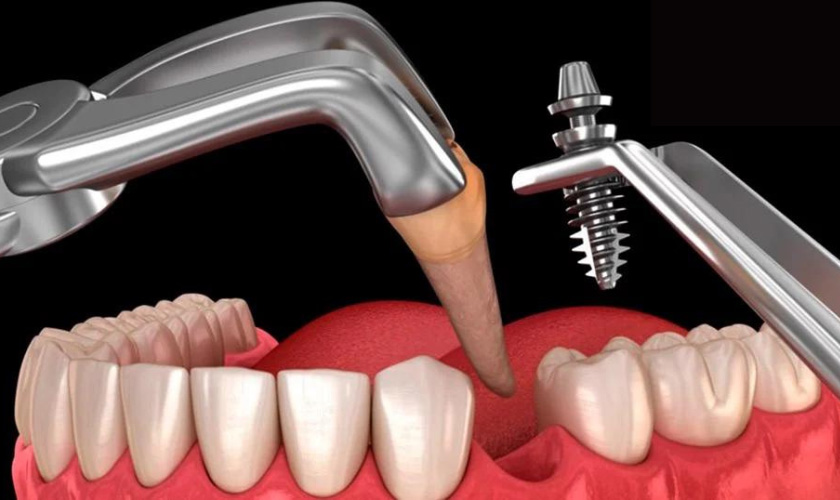 Răng nhổ sau bao lâu thì trồng Implant lại được? 6-12 tháng