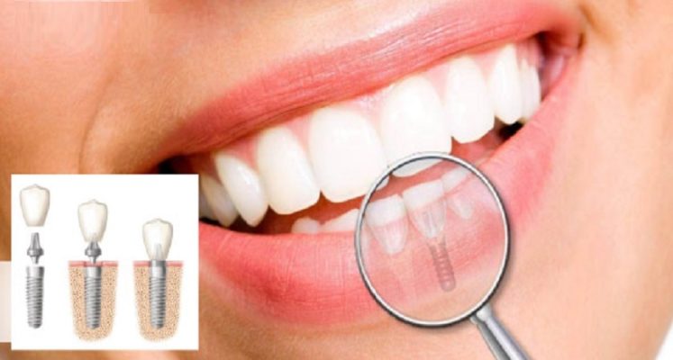 Sau khi nhổ răng thì nên trồng răng Implant sớm nhất có thể