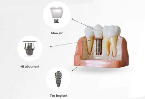 Răng Implant có khả năng khôi phục đầy đủ cấu trúc của răng tự nhiên
