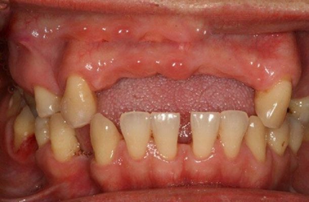 Thời gian điều trị sẽ lâu hơn trong trường hợp tiêu xương do mất răng lâu năm