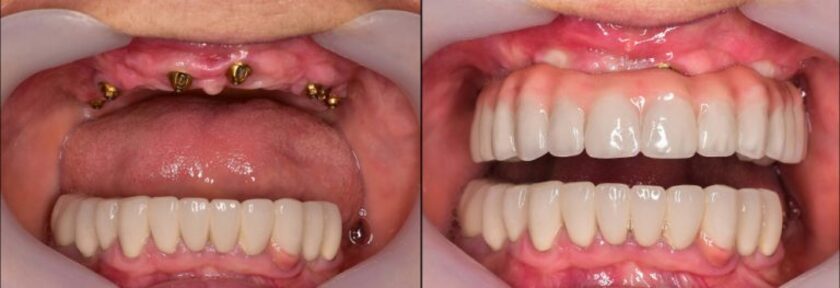 Implant All on 4 là kỹ thuật cấy ghép phục hình răng toàn hàm hiện đại