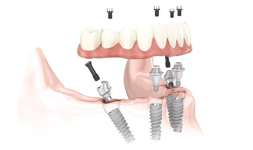 Trồng răng Implant All on 4 giá bao nhiêu sẽ tùy thuộc vào tình trạng mỗi người