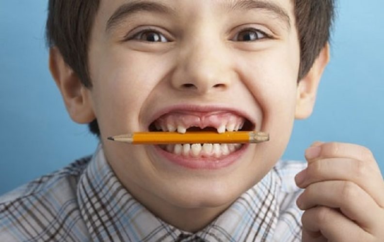 Trẻ em dưới 18 tuổi không nên phẫu thuật trồng răng Implant