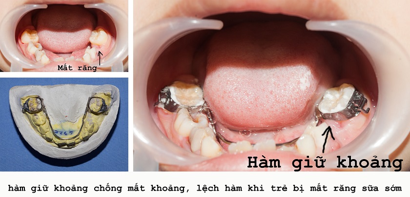 Dùng hàm giữ khoảng trong thời gian đợi trẻ đủ tuổi trồng răng Implant