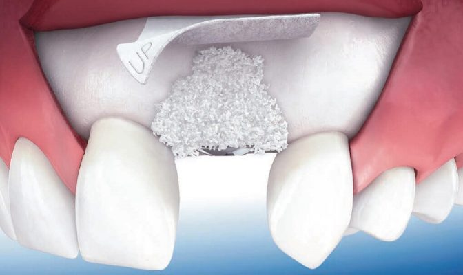 Ghép xương trong phục hình răng Implant