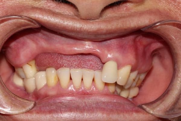 Mất răng lâu năm khiến xương hàm tiêu biến cần ghép thêm xương trước khi trồng Implant