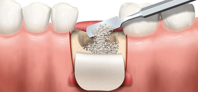 Ghép xương nhân tạo là kỹ thuật được sử dụng nhiều nhất hiện nay