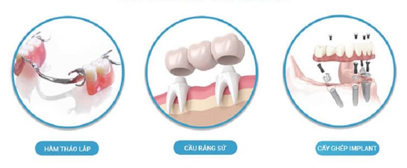 Răng Implant có tuổi thọ cao vượt trội so với các phương pháp phục hình khác