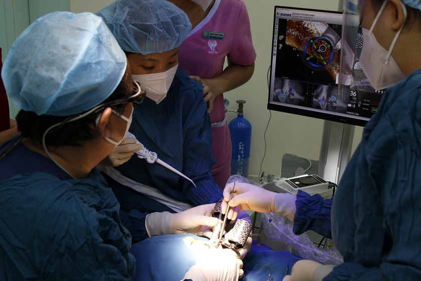 Khám phá ngay giá trồng răng sứ Implant chi tiết nhất 2023 29 Tại Implant Center thời gian trồng Implant khoảng 15 đến 30 phút cho mỗi trụ