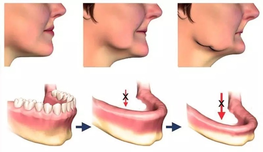Thời gian điều trị dài hơn ở khách hàng bị tiêu xương