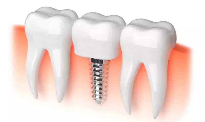 Trồng răng Implant thất bại nguyên nhân và khắc phục