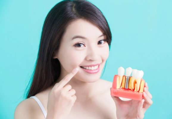 Trồng răng Implant mang tính thẩm mỹ cao