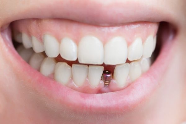 Răng Implant có thể sử dụng vĩnh viễn
