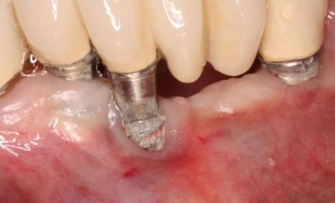 Trồng răng Implant xi măng đã xuất hiện từ rất lâu