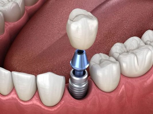 Trồng răng Implant bắt vít sử dụng công nghệ bắt vít SSI từ Singapore