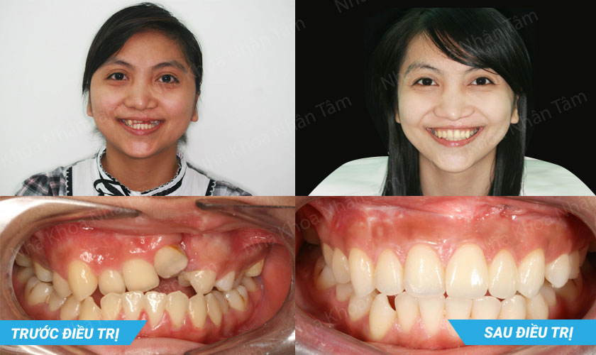 Ca lâm sàng cấy ghép Implant thành công cho người bị khe hở môi - vòm miệng