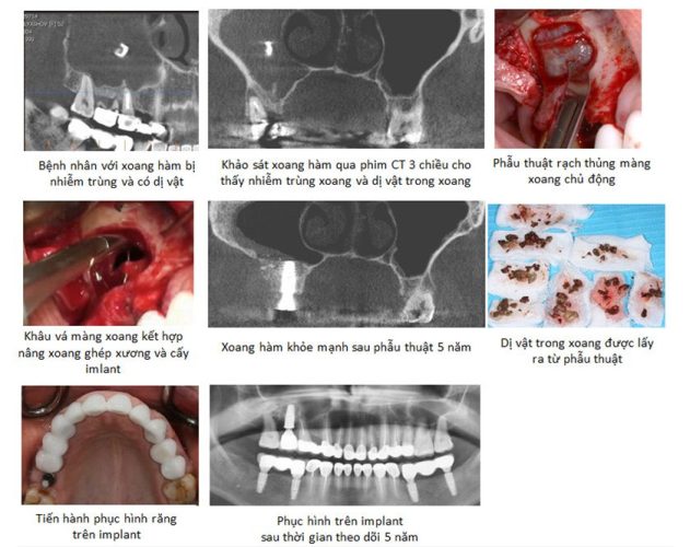 Ca lâm sàng khâu vá màng xoang tại Implant Center