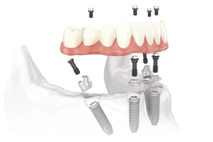 Các thành phần trong cấy ghép Implant All on X