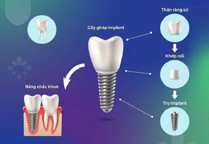 Cấu tạo tương tự răng thật của một chiếc răng Implant