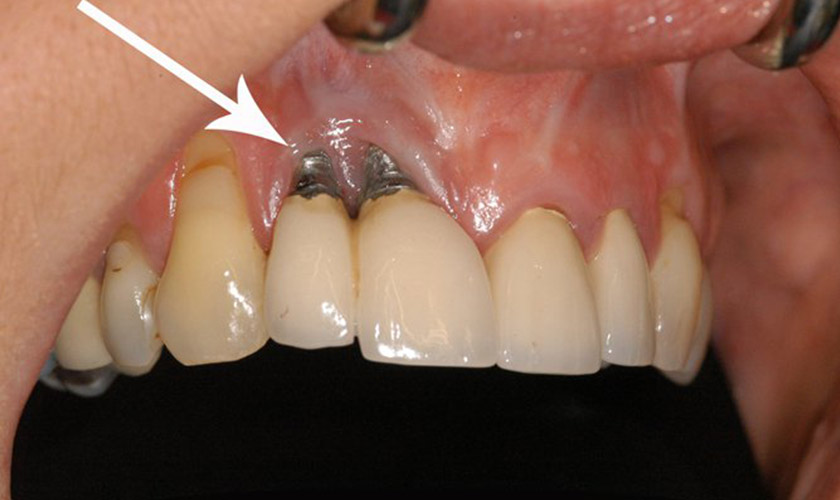Hậu quả khi không tuân thủ quy trình trồng răng Implant