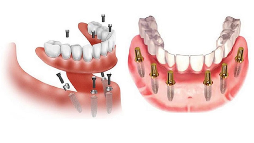 Implant All on X cần đặt bao nhiêu trụ Implant