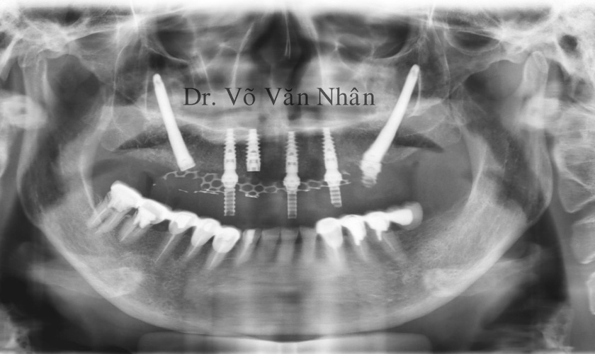 Phương pháp cấy Implant xương gò má – Zygoma Implant 3 Implant xương gò má được ứng dụng trong trường hợp mất răng toàn hàm, xương bị tiêu biến nghiêm trọng