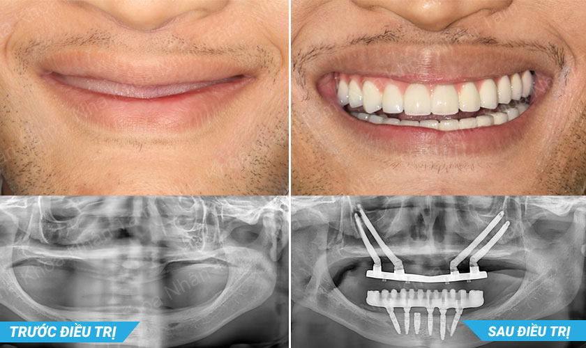 Phương pháp cấy Implant xương gò má – Zygoma Implant 5 Khách hàng sau khi cấy Implant xương gò má tại Implant Center