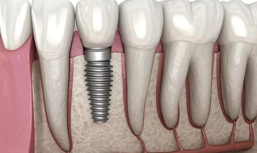 Khâu vá màng xoang giúp thúc đẩy quá trình tích hợp xương và trụ Implant nhanh hơn