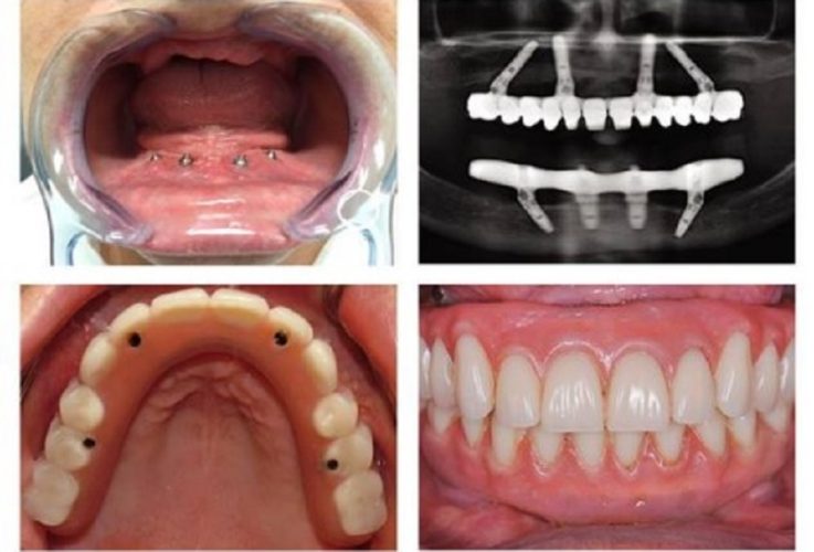 Khôi phục lại toàn bộ hàm răng với Implant All on 4