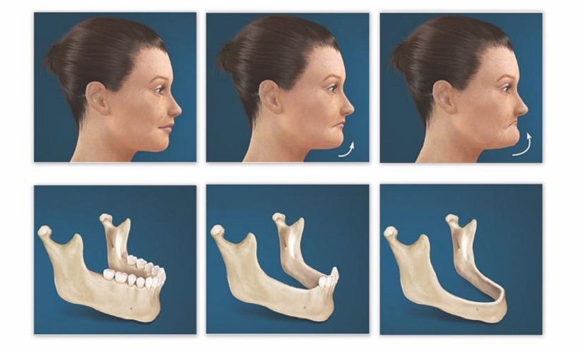 Không răng và tiêu xương hàm gây ảnh hưởng nghiêm trọng đến cấu trúc khuôn mặt