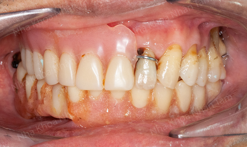 Ông Lượm phải đeo hàm tháo lắp cổ điển, lỏng lẻo theo thời gian và thường xuyên xộc xệch trong miệng