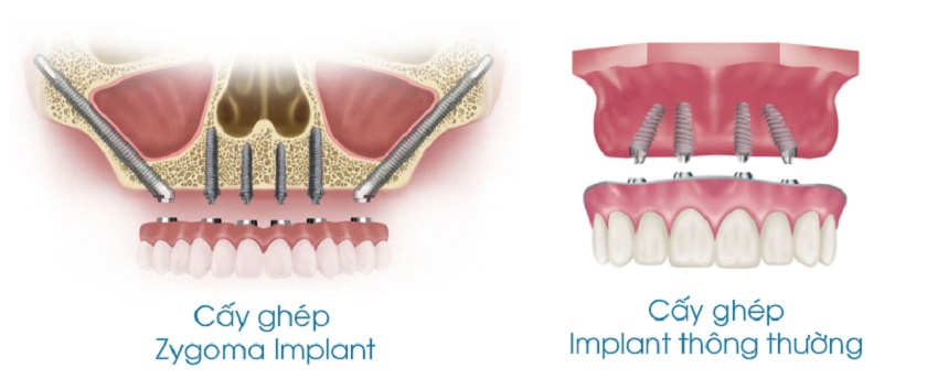 Phương pháp cấy Implant xương gò má – Zygoma Implant 2 Phương pháp cấy Implant xương gò má và cấy Implant thông thường