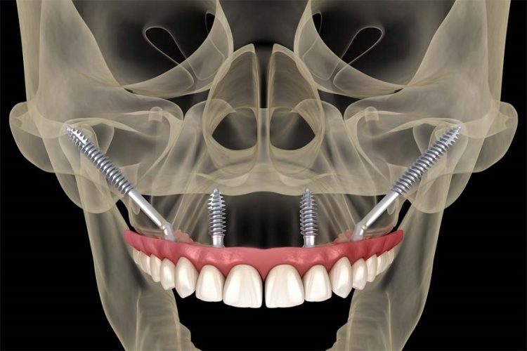 Một phương pháp trồng răng cho người không răng bẩm sinh | Implant Center