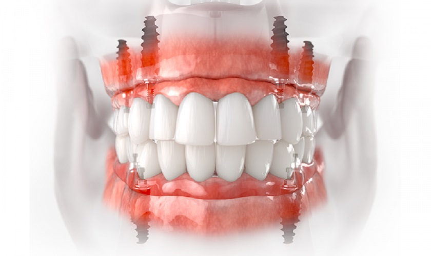 Răng giả phục hình bằng Implant All on 4 có thể bền chắc tới trọn đời