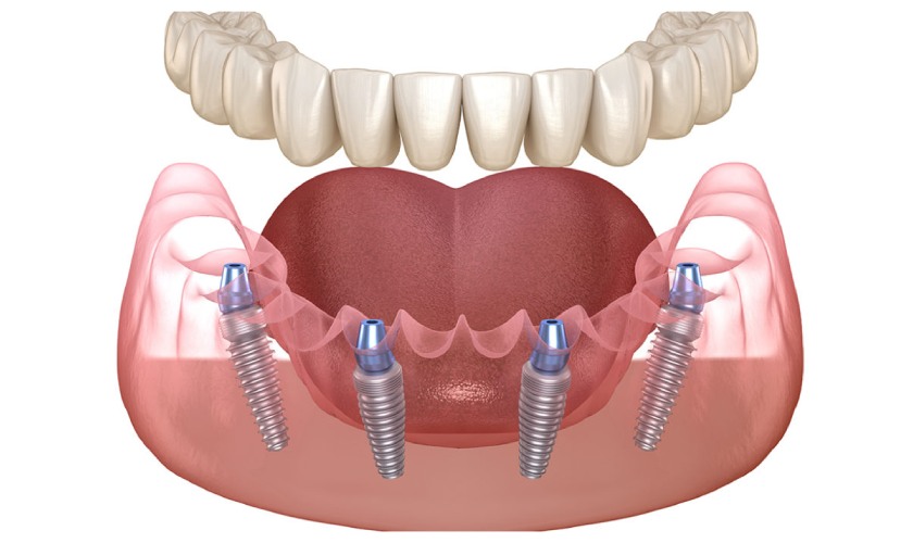 Trồng răng Implant All on 4 có chi phí khá cao