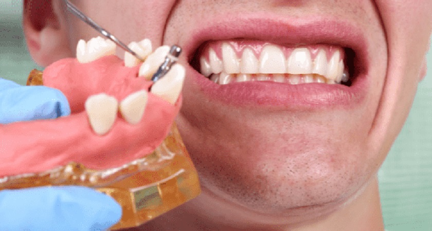 Trồng răng Implant và phục hình tức thì giúp rút ngắn tối đa thời gian điều trị | Implant Center