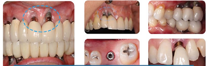 Trồng răng Implant nha khoa không uy tín dẫn đến hậu quả không lường