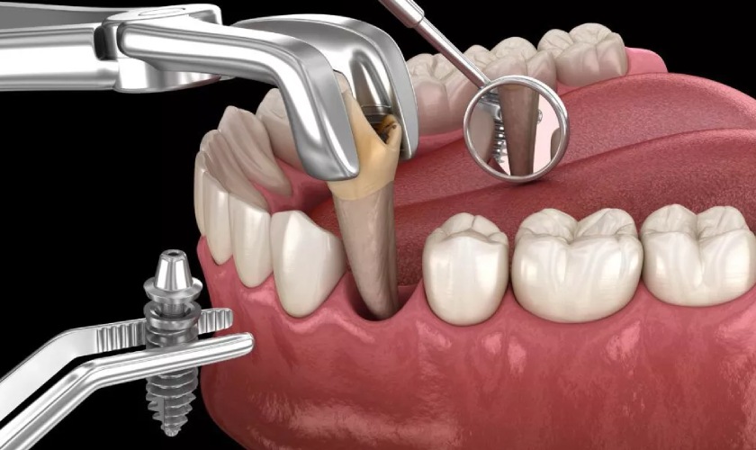 Trồng răng Implant và phục hình tức thì giúp có răng nhanh chóng