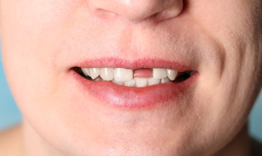 Trường hợp mất răng nhưng xương hàm vẫn còn tốt thích hợp để trồng Implant tức thì | Implant Center