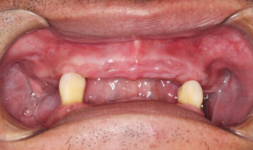 Trường hợp mất răng toàn hàm được chỉ định trồng răng Implant All on X