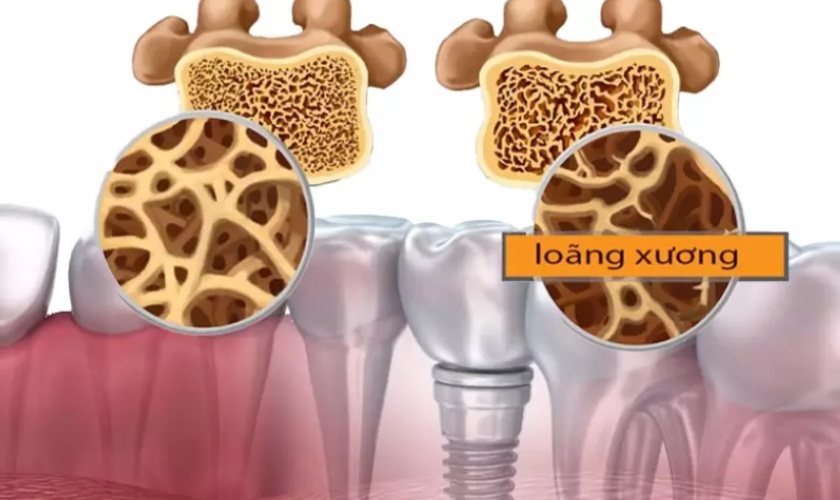 Bị loãng xương có trồng Implant được không