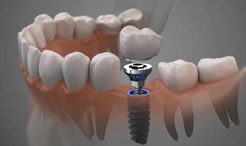 Cấy ghép Implant tác động trực tiếp vào xương hàm nên có thể gây sưng mặt
