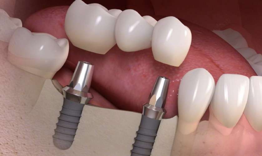 Cầu răng sứ trên Implant và ưu điểm nổi bật