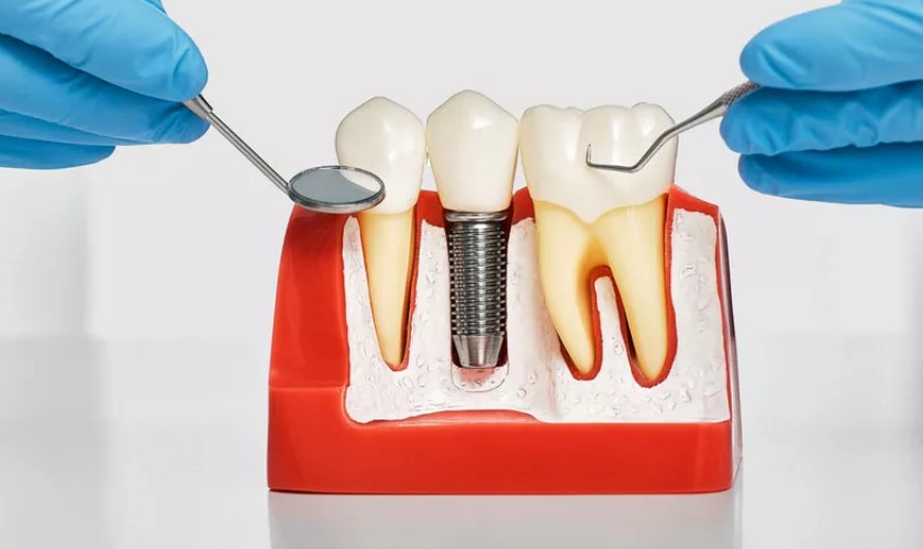 Cấy ghép Implant bệnh nhân khe hở môi | Implant Center