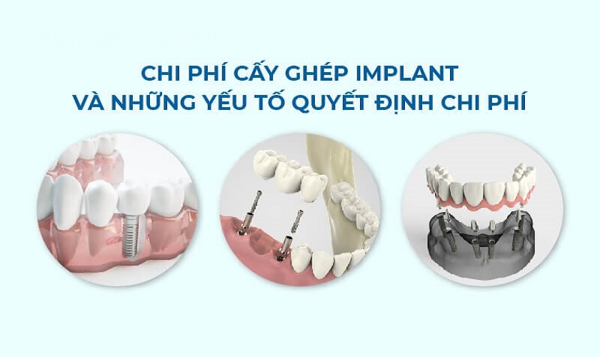 Implant Center cấy ghép Implant giá bao nhiêu