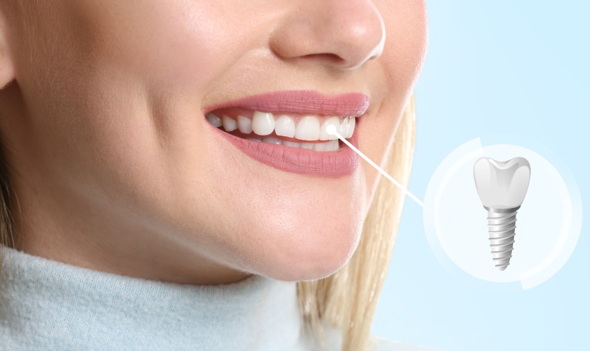 Cấy ghép Implant tức thì được nhiều người ưa chuộng