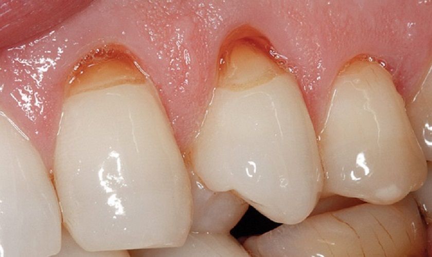 Chân răng bị mục – Nguyên nhân, dấu hiệu và cách khắc phục